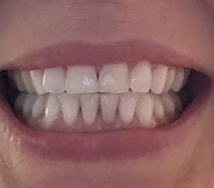 Novashine Professional Teeth Whitening Kit: Advanced Blue LED Light, Concentrated Peroxide Gel, Smartphone Adapter, Travel Bag customer photo 2