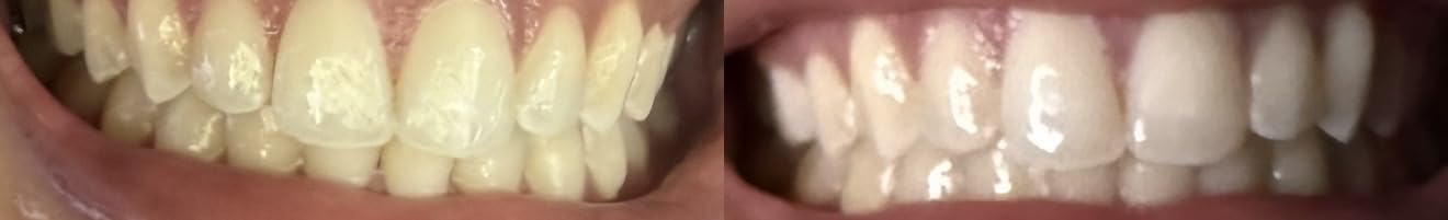 Lumineux Teeth Whitening Strips, Peroxide Free, 9 Treatments (1 Month) | Peroxide free, enamel safe, dentist formulated, clinically tested & proven, free from harsh ingredients, no sensitivity customer photo 1