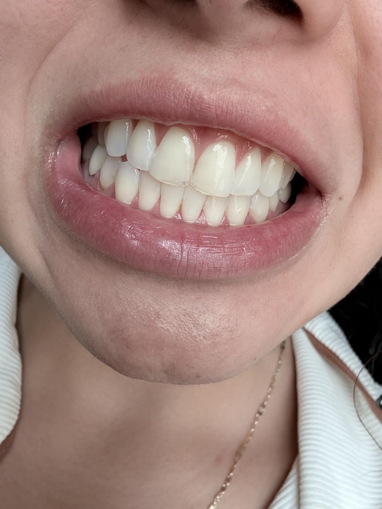 Crest 3DWhitestrips Sensitive White At-Home Teeth Whitening Kit, 18 Treatments, Gently Removes 15 Years of Stains customer photo 2