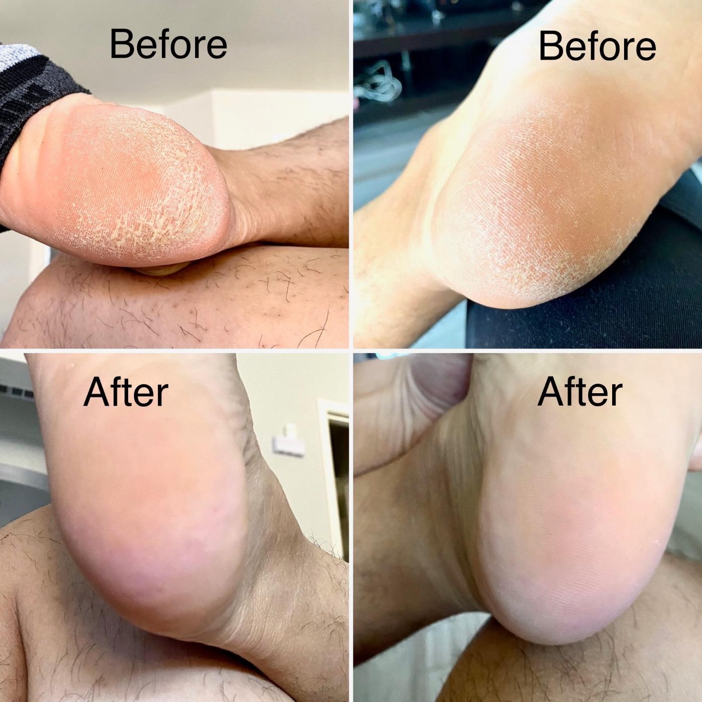 Electric Foot Callus Remover Kit, Elmchee Rechargeable Callous removers 3 Grinding Heads Waterproof Foot Scrubber File, Professional Pedicure Tools kit Feet Care for Dead, Cracked Dry Skin customer photo 1